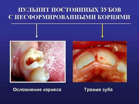 Пульпит постоянных несформированных зубов у детей ПУЛЬПИТ