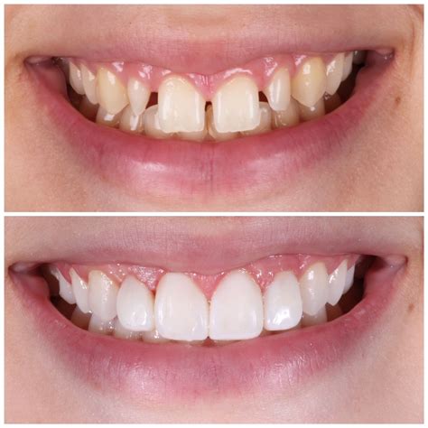 Peg laterals restored with Composite Veneers in 2024 | Cosmetic dental ...