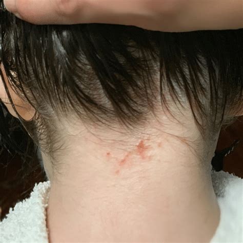 Lice Bites and Rashes Video Tutorial - My Lice Advice