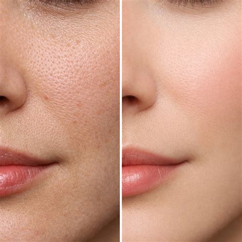 orange peel skin  treatments    improve skin texture