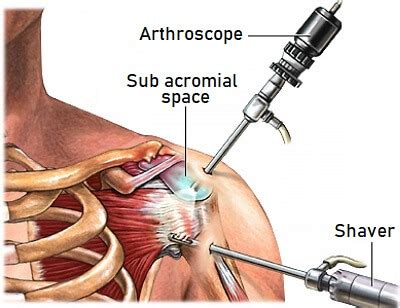 Arthroscopic Surgery Shoulder | Dr Reetadyuti Mukhopadhyay