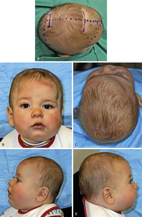 Multiple Suture Nonsyndromic Craniosynostosis - Clinical Tree
