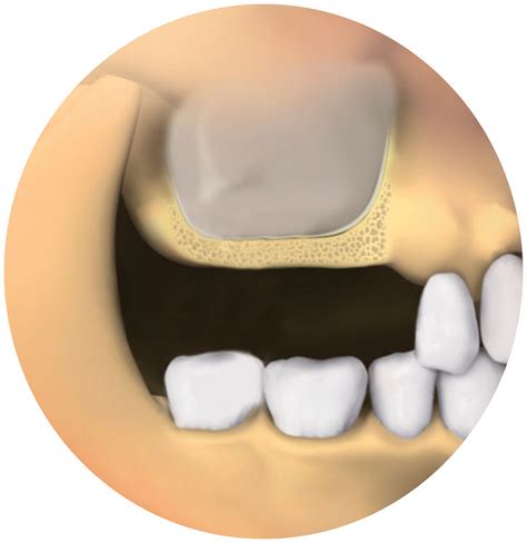 Patient: Sinus lifts/bone grafts | Southern Implants