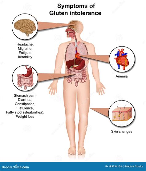 Gluten Intolerance Infographic, 3d Medical Vector Illustration Isolated