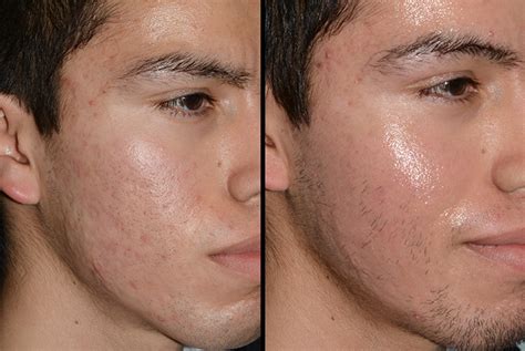 Acne Scar Treatment Salt Lake City | Gateway Aesthetic