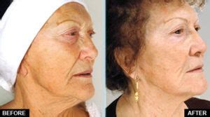 Peeling Ultrassônico Antes E Depois