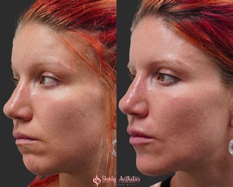 Chin Fillers - Before & After Results at Skinly