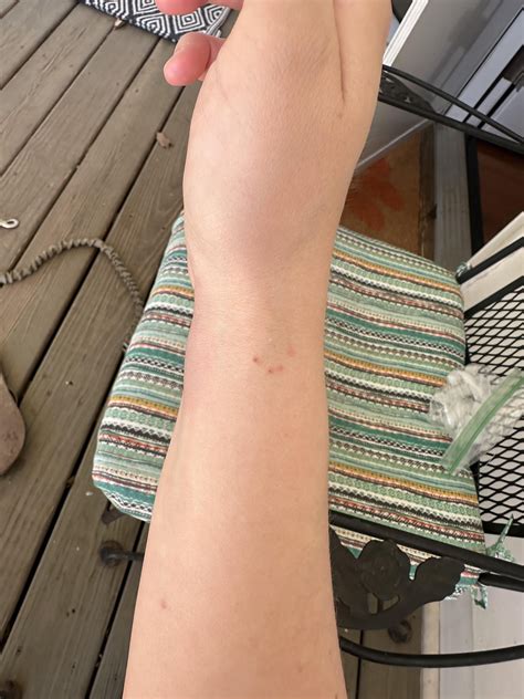 Biggest spot popped on camera causes a viral health sensation 8