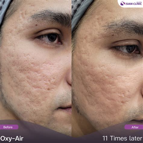 Acne Treatment Before and After Photos - Siam Clinic Thailand