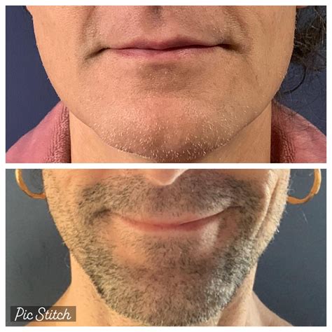Laser hair removal results after 12 sessions. Each photo represents