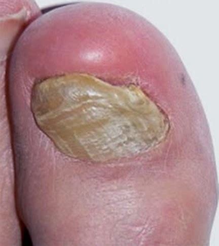 Toenail Fungus - Pictures, Symptoms, Causes, Treatment