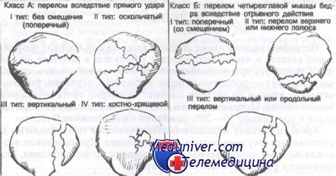 Переломы надколенника. Классификация, диагностика и лечение