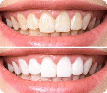 Exposed Tooth Root Symptoms, Causes, And Treatments – NatruSmile