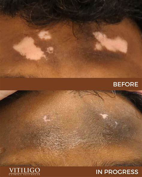 Vitiligo Before and After Treatment - Vitiligo Clinics Australia