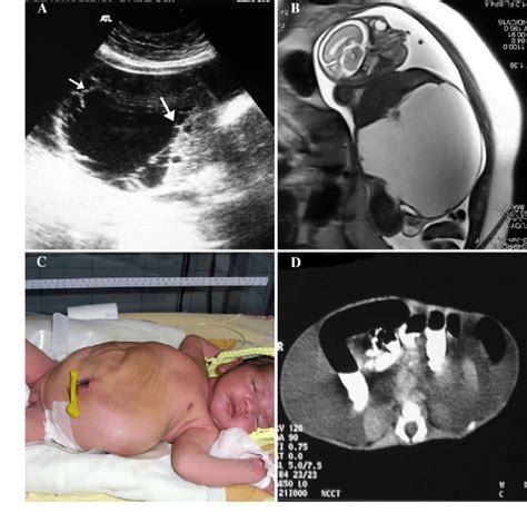 week fetus  chylous ascitis  axial grayscale sonogram shows