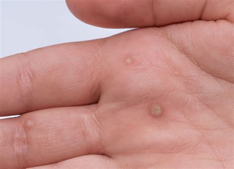 can warts spread from hand to face 5