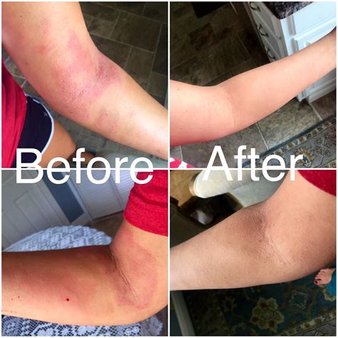 85 best Dupixent images on Pholder | Eczema, Ecze MA Bs and Commercials