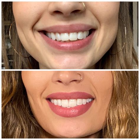 filing  front teeth rinvisalign