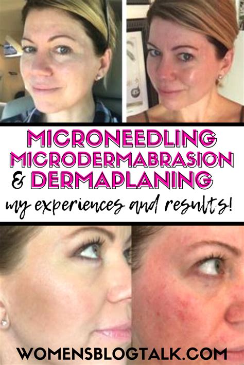 Microneedling vs Microdermabrasion vs Dermaplaning: Before and After Photos