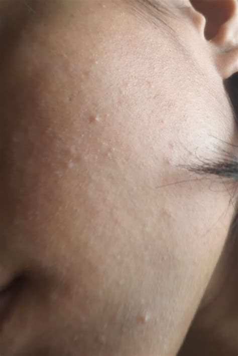 how to get rid of bumpy facial skin