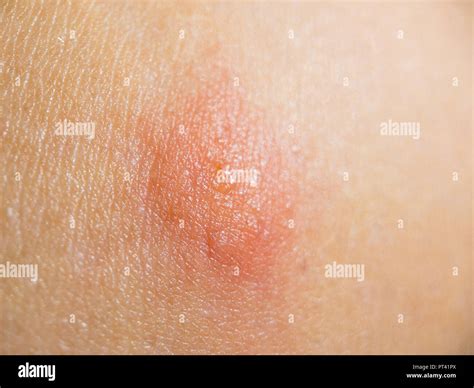 Bite insect on female skin Stock Photo - Alamy