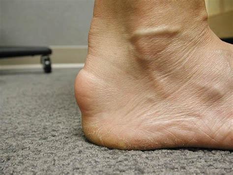 ACHILLES TENDONITIS AND PLANTAR FASCIITIS