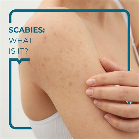 Scabies: symptoms, treatments, and prevention - Alegria Medical Centre