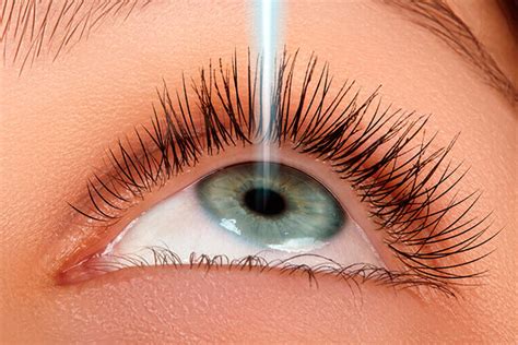 Iridotomia a laser – Instituto Ocular