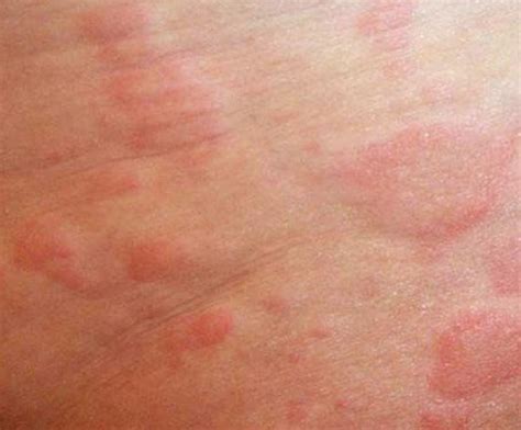 An Introduction To The Types Of Itchy Skin Rashes The - vrogue.co