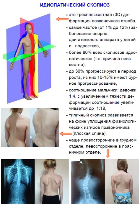 Ортопедическая клиника Галины Панкратовой (Ортоклиника): Идиопатический ...