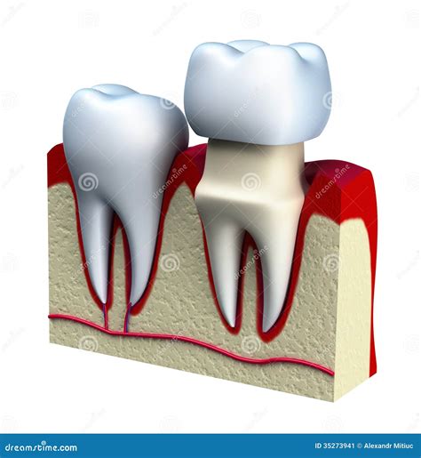 Dental Crown Installation Process, Isolated on White Stock Illustration