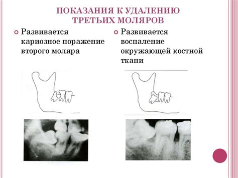 Удаление третьих моляров верхней и нижней челюсти. Ретенция и дистопия ...
