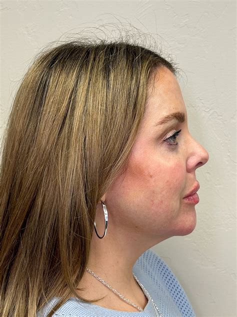 Patient 148023472 | Full Face Filler Before & After Photos | Highwater ...