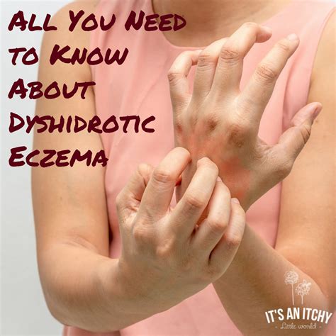 What is Dyshidrotic Eczema? | It's an Itchy Little World