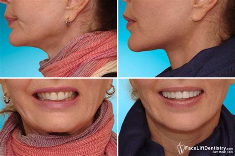 overbite correction