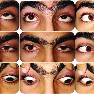 Pre-operative 9-gaze clinical picture | Download Scientific Diagram