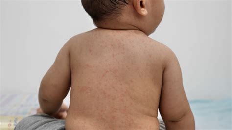 measles outbreak whos  risk  whos  immune  virus