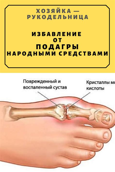 Лечение подагры народными средствами — Хозяйка — Рукодельница