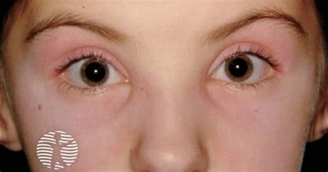 Dermatomyositis of eyelids image