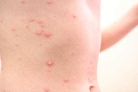 Viral Rash On Face