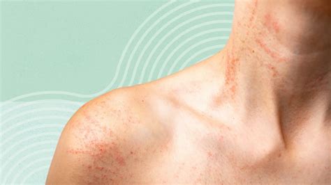 rashes  skin folds  home remedies