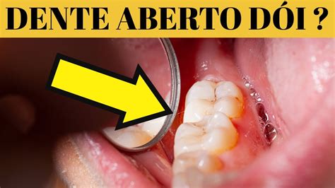 Dente Aberto Pode Matar