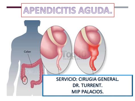 (PPT) APENDICITIS AGUDA