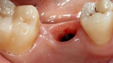 Alveolitis After Tooth Extraction: Causes, Symptoms and Treatments ...