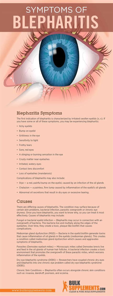 Blepharitis Causes Signs And Symptoms Home Remedies Treatment – NBKomputer