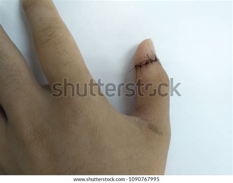 Wound Caused By Knife Cutter Stock Photo 1090767995 | Shutterstock