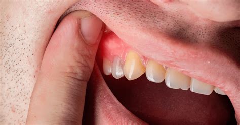 Absceso Periodontal: Síntomas, Tratamiento Y Prevención