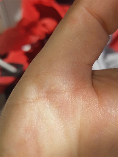 Small bumps on hands, kinda hard to see but they are all over my hands