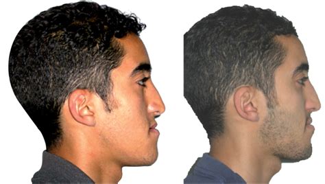 Dentofacial Deformities Integrated Orthodontic And Surgical Correction 9