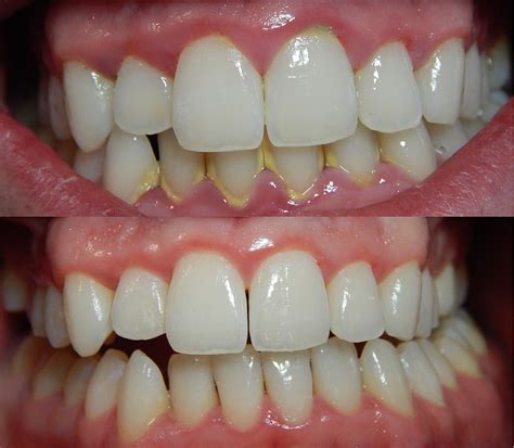 how to fix gingivitis at home
